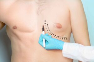 gynecomastie istanbul